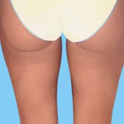 Liposuction Before & After Patient #2447
