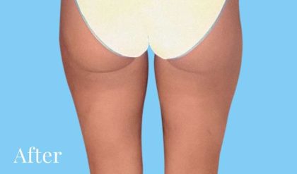 Liposuction Before & After Patient #2447