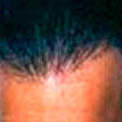 Hair Restoration Before & After Patient #2790