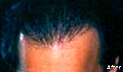 Hair Restoration Before & After Patient #2790