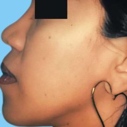 Rhinoplasty Before & After Patient #2994