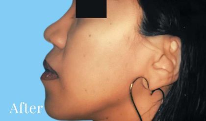 Rhinoplasty Before & After Patient #2994