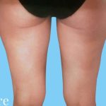 Liposuction Before & After Patient #2447