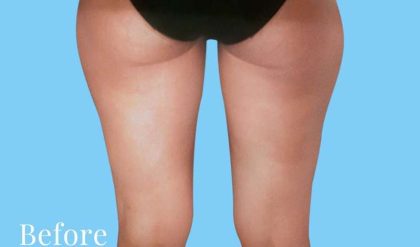 Liposuction Before & After Patient #2447