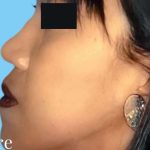 Rhinoplasty Before & After Patient #2994