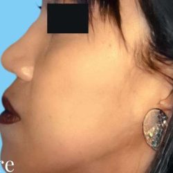 Rhinoplasty Before & After Patient #2994