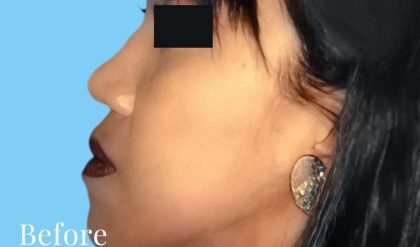 Rhinoplasty Before & After Patient #2994
