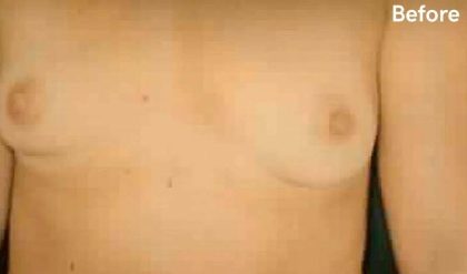 Breast Augmentation Before & After Patient #2245