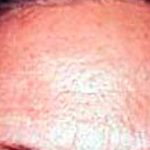 Botox Before & After Patient #2154
