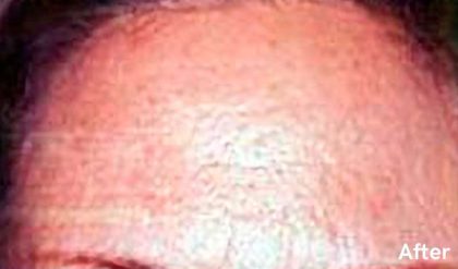 Botox Before & After Patient #2154