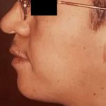 Chin Implants Before & After Patient #2477