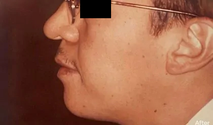 Chin Implants Before & After Patient #2477