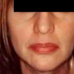 Chin Liposuction Before & After Patient #2486