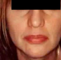Chin Liposuction Before & After Patient #2486