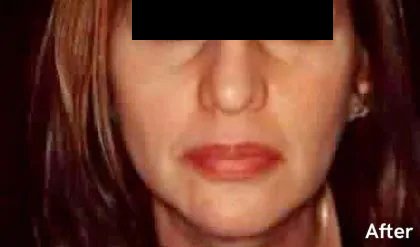 Chin Liposuction Before & After Patient #2486