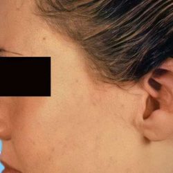 Otoplasty Before & After Patient #2556