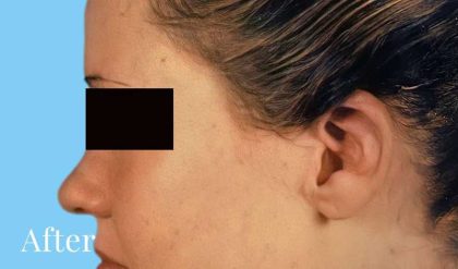 Otoplasty Before & After Patient #2556