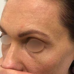 Eyebrow Restoration Before & After Patient #2570