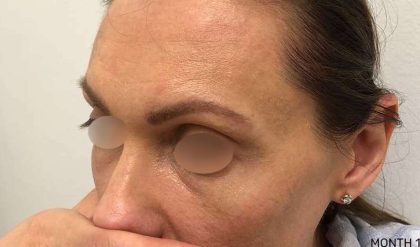 Eyebrow Restoration Before & After Patient #2570