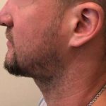 Beard Restoration Before & After Patient #2151