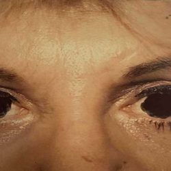 Eyelid Surgery Before & After Patient #2608