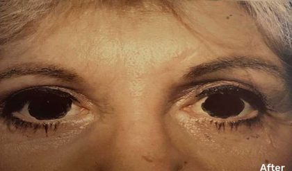 Eyelid Surgery Before & After Patient #2608