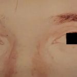 Eyelid Surgery Male Before & After Patient #2632