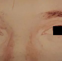 Eyelid Surgery Male Before & After Patient #2632