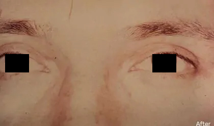 Eyelid Surgery Male Before & After Patient #2632