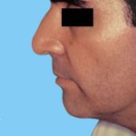 Facelift Male Before & After Patient #2668