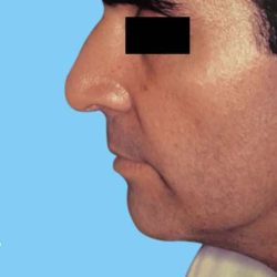 Facelift Male Before & After Patient #2668