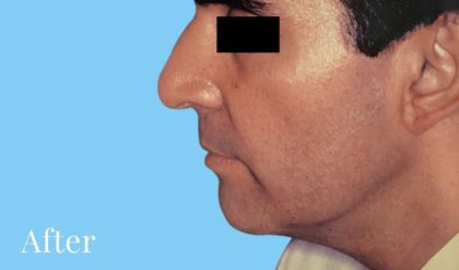 Facelift Male Before & After Patient #2668