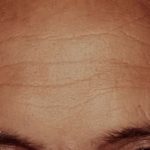 Botox Male Before & After Patient #2166