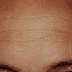 Botox Male Before & After Patient #2166