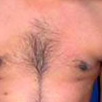 Gynecomastia Before & After Patient #2707