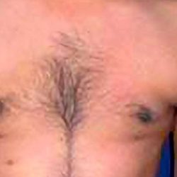 Gynecomastia Before & After Patient #2707