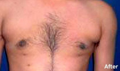 Gynecomastia Before & After Patient #2707