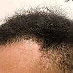 Hair Restoration Before & After Patient #2757