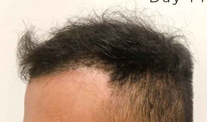 Hair Restoration Before & After Patient #2757