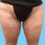 Liposuction Before & After Patient #2835