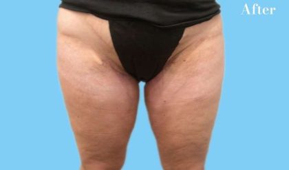 Liposuction Before & After Patient #2835