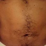 Liposuction Male Before & After Patient #2894