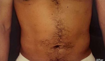 Liposuction Male Before & After Patient #2894