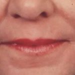 Microneedling Before & After Patient #2924