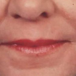 Microneedling Before & After Patient #2924