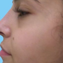 Rhinoplasty Before & After Patient #2967