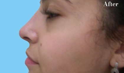 Rhinoplasty Before & After Patient #2967