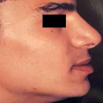 Rhinoplasty Male Before & After Patient #3015