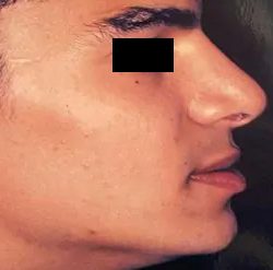 Rhinoplasty Male Before & After Patient #3015