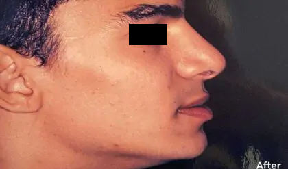 Rhinoplasty Male Before & After Patient #3015
